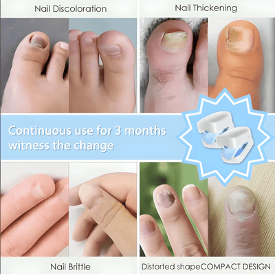 ClearNail Laser - Aureon LabsClearNail Laser